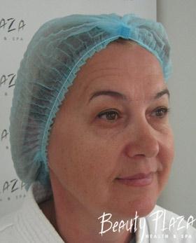 лифтинг
